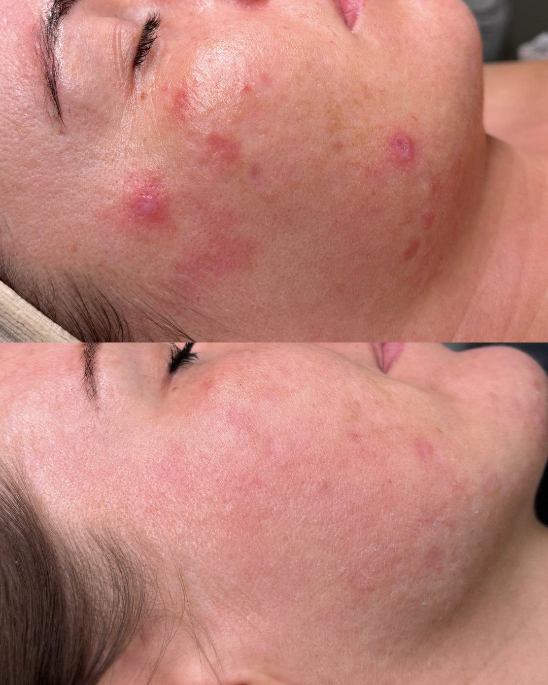 Biopeeling i oczyszczanie wodorowe - efekt oczyszczenia i wygładzenia