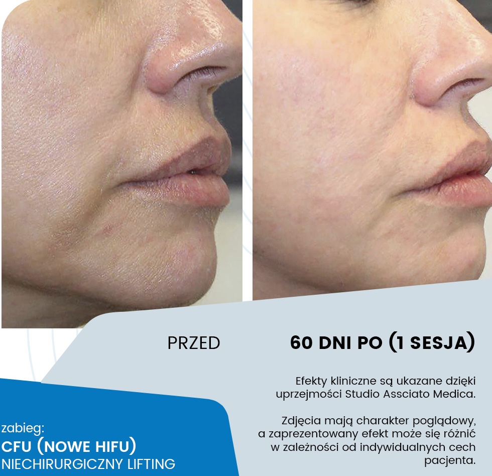 CFU - lifting ultradźwiękowy - przygotowanie do zabiegu