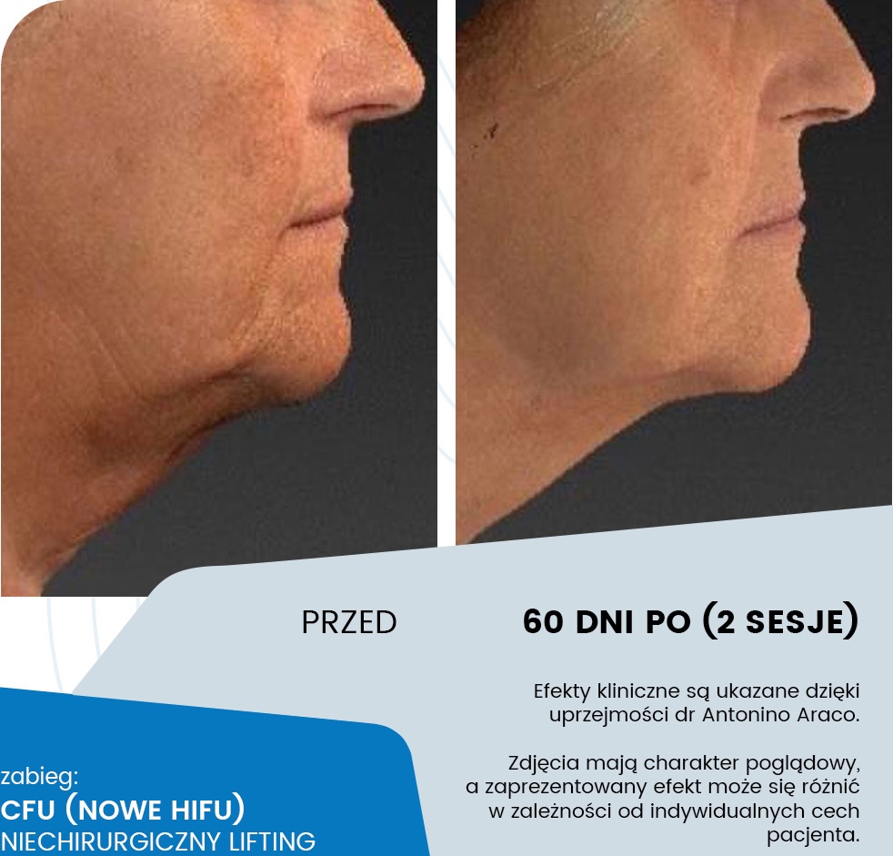 CFU - lifting ultradźwiękowy - przebieg terapii