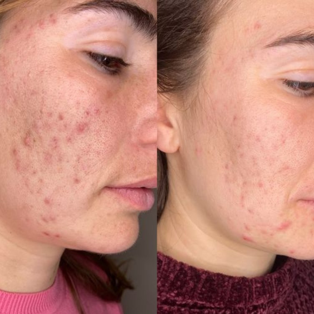 Dermalux Flex - efekt przed i po serii zabiegów (4)