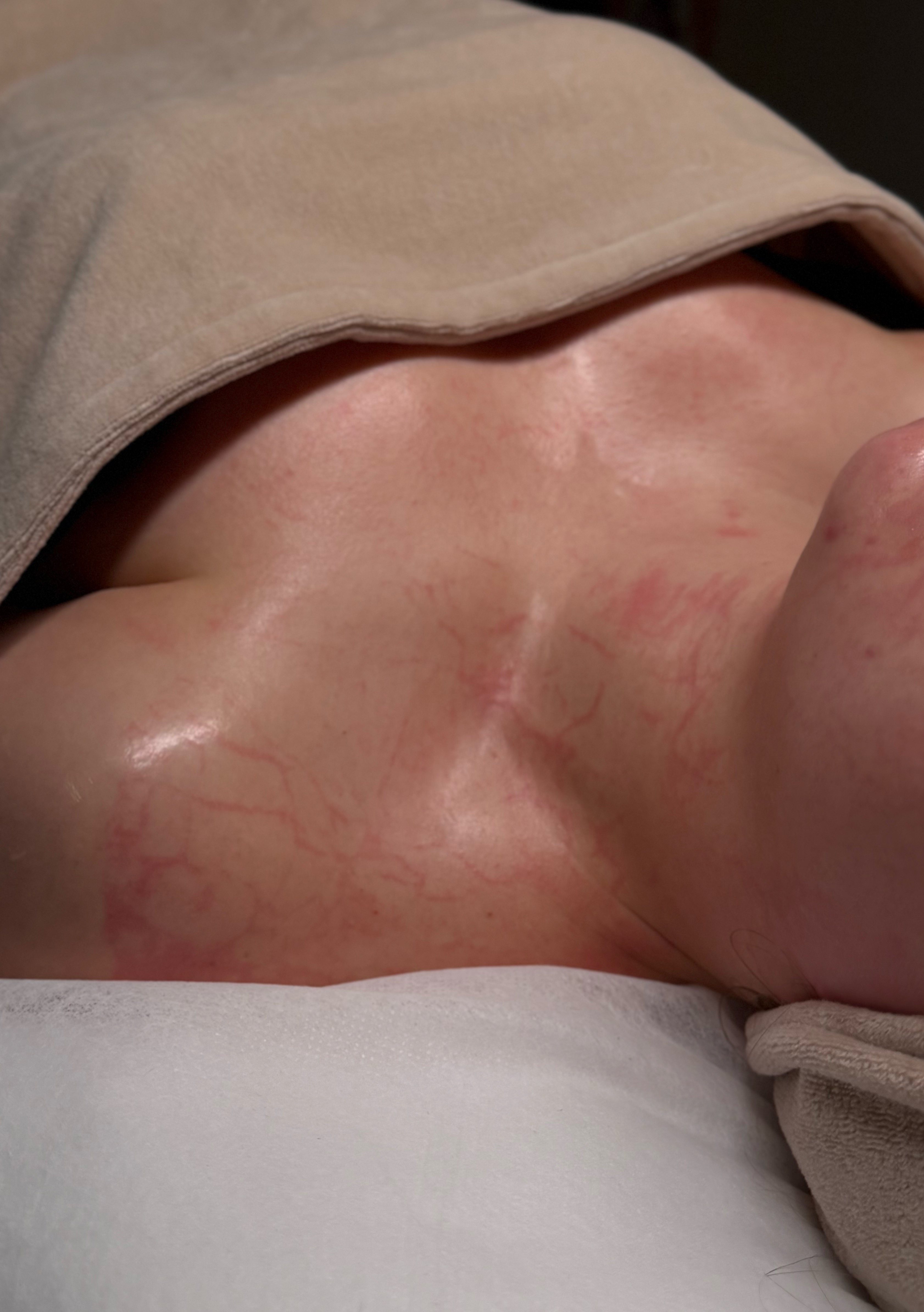 Terapia enzymatyczna DMK - etap zabiegowy