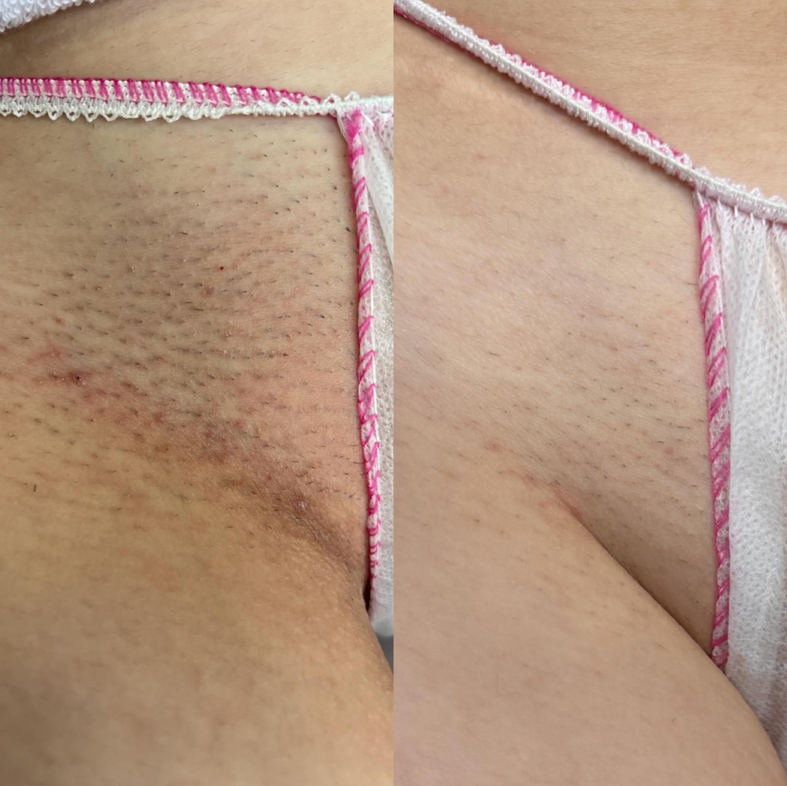Efekt epilacji laserowej okolicy bikini - przed zabiegiem i po serii