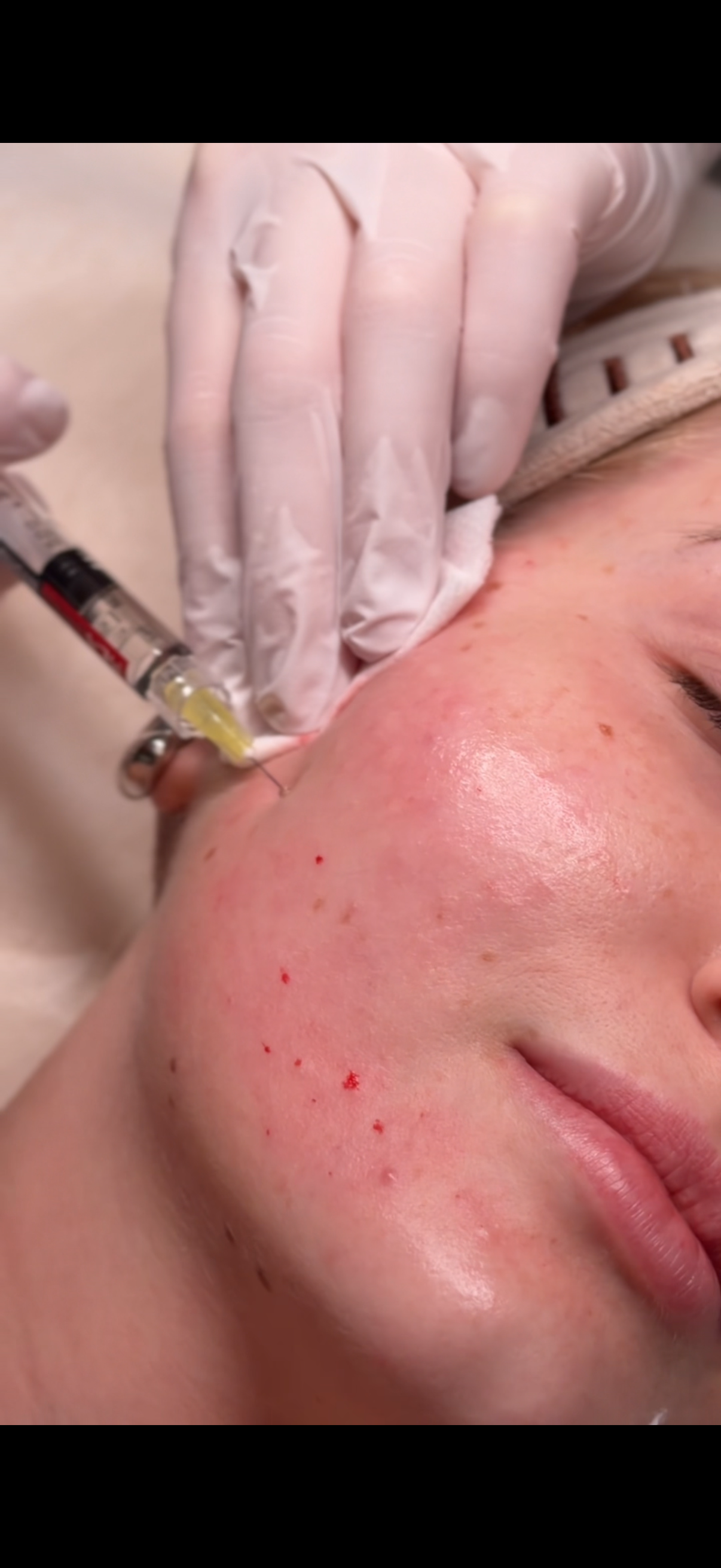 Mezoterapia igłowa - nawilżenie i regeneracja skóry