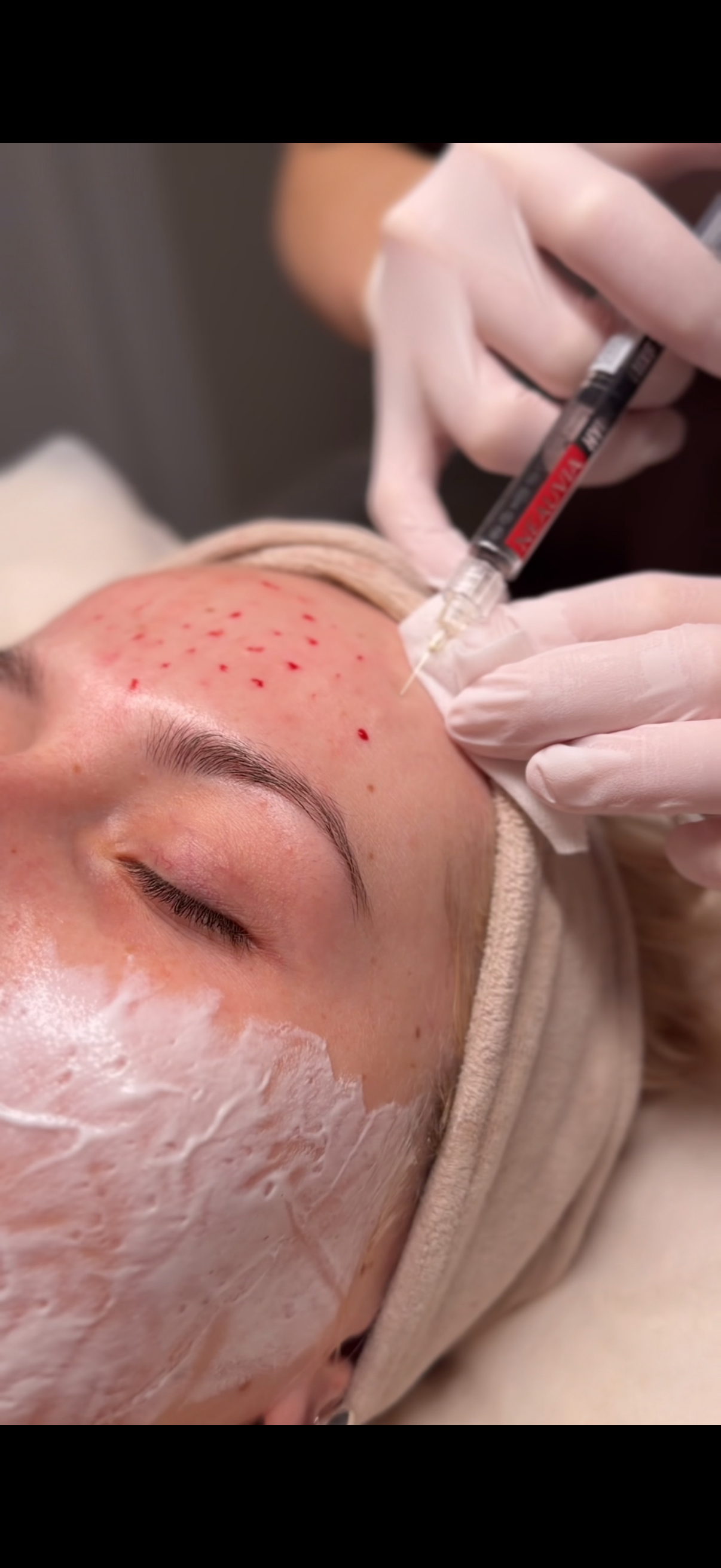 Mezoterapia igłowa - precyzyjna technika mikronakłuć