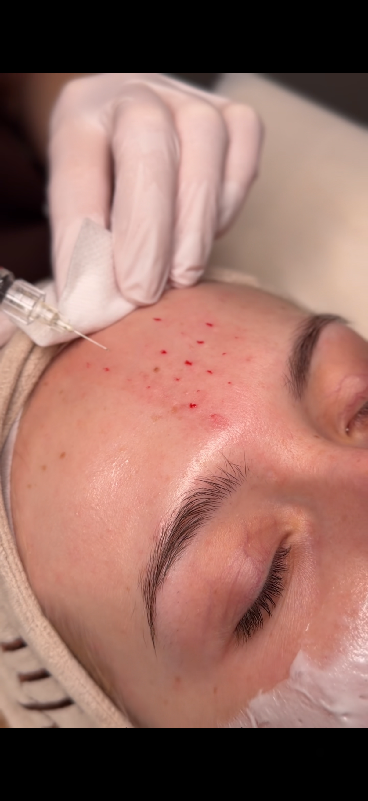 Mezoterapia igłowa - efekt promiennej skóry po serii zabiegów