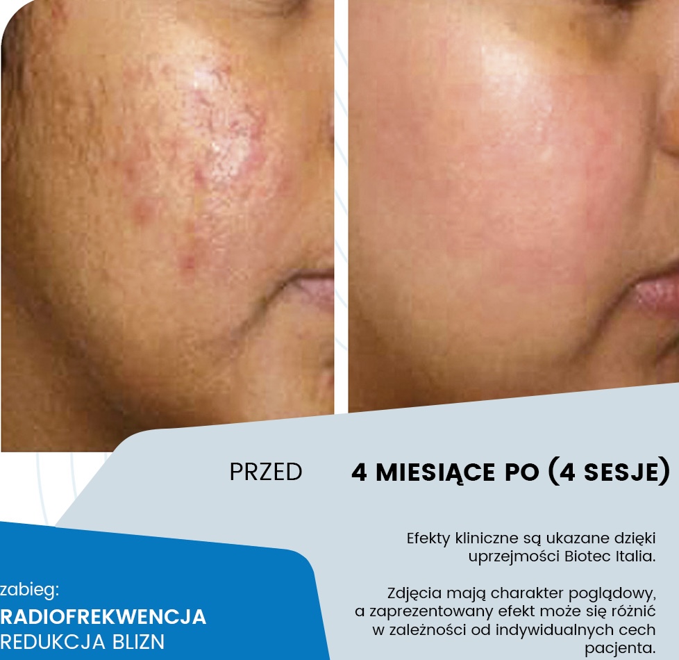 Radiofrekwencja RF Shape - przygotowanie skóry