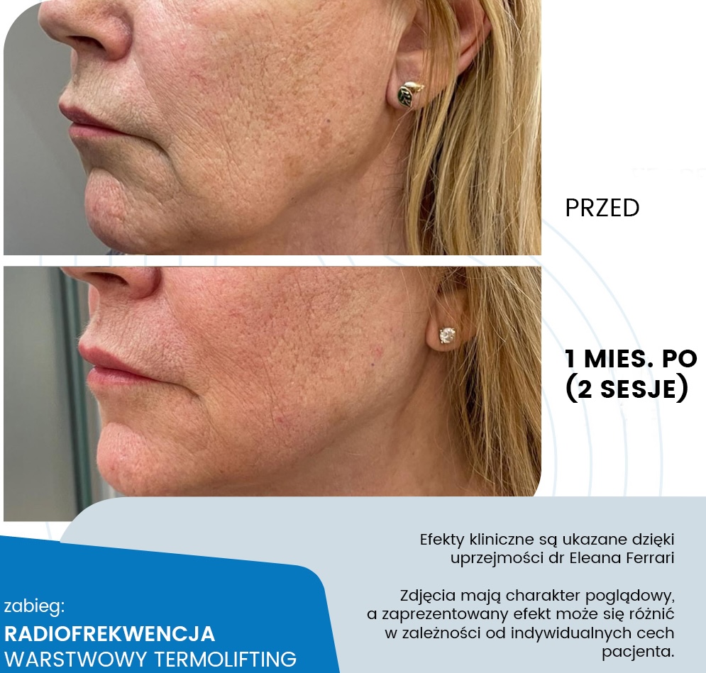 Radiofrekwencja RF Shape - praca głowicą zabiegową