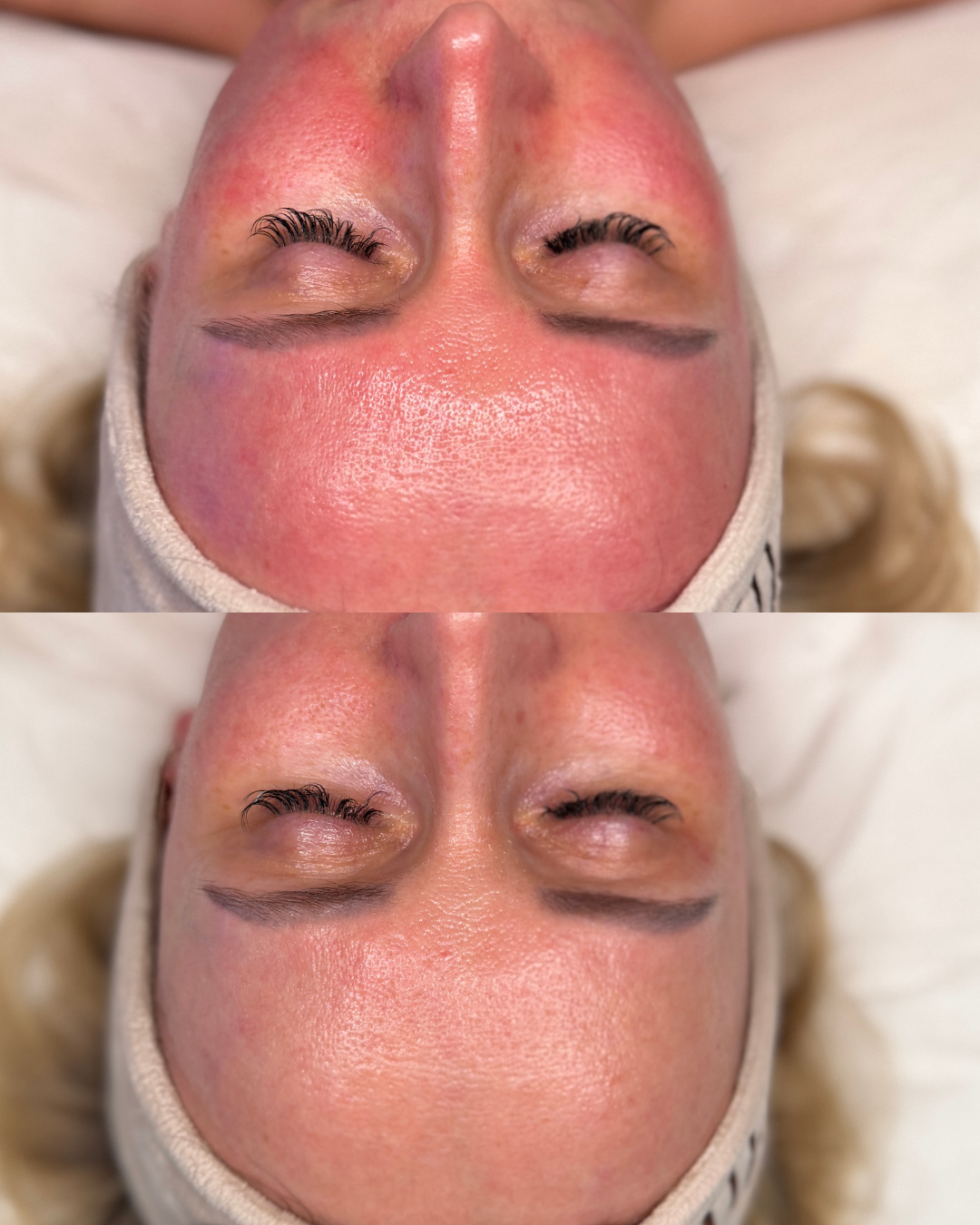 Terapia dla skóry suchej - efekt ukojenia i komfortu